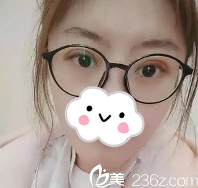 双眼皮手术7天后 双眼皮手术7天后