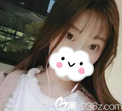 崔锡勋院长双眼皮手术案例分享 崔锡勋院长双眼皮手术案例分享