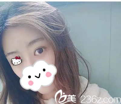 双眼皮手术45天后恢复情况 双眼皮手术45天后恢复情况