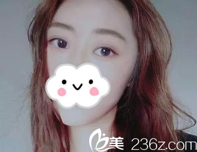 韩国狎鸥亭艾薇整形外科双眼皮手术案例 韩国狎鸥亭艾薇整形外科双眼皮手术案例