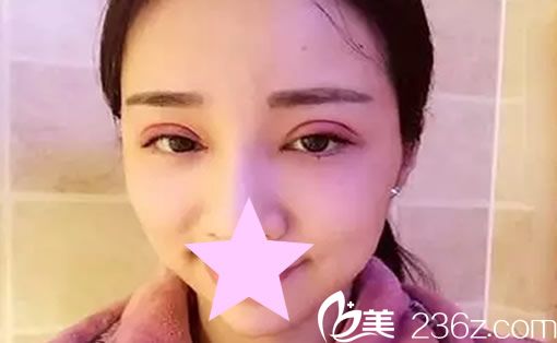 全切双眼皮术后第二天 全切双眼皮术后第二天