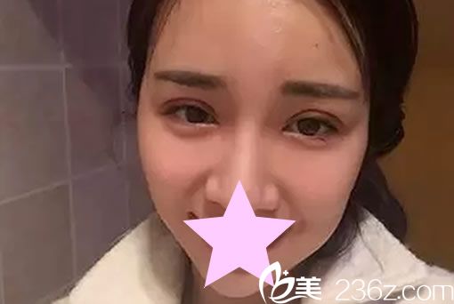 全切双眼皮7天恢复图片 全切双眼皮7天恢复图片