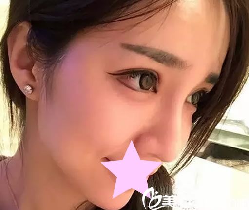 双眼皮10天恢复图 双眼皮10天恢复图