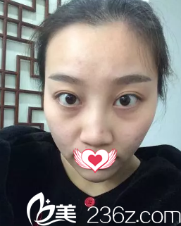 术前鼻梁塌平 术前鼻梁塌平