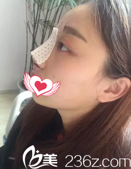 刚做完隆鼻手术鼻子微肿 刚做完隆鼻手术鼻子微肿
