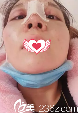 假体隆鼻5天后手术痕迹恢复不明显 假体隆鼻5天后手术痕迹恢复不明显