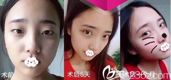 淮北微悦双眼皮恢复过程图