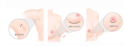 假体隆胸手术切口