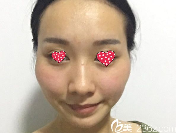 呼和浩特京美整形医院自体脂肪填充全脸前 呼和浩特京美整形医院自体脂肪填充全脸前