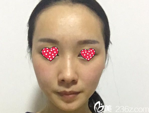 面部脂肪填充第7天 面部脂肪填充第7天