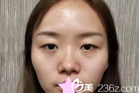 呼市京美整形双眼皮整形失败修复+隆鼻前 呼市京美整形双眼皮整形失败修复+隆鼻前