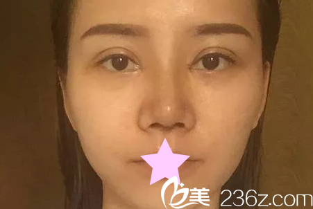 全切双眼皮+综合隆鼻第5天 全切双眼皮+综合隆鼻第5天