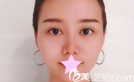 全切双眼皮+综合隆鼻半个月 全切双眼皮+综合隆鼻半个月