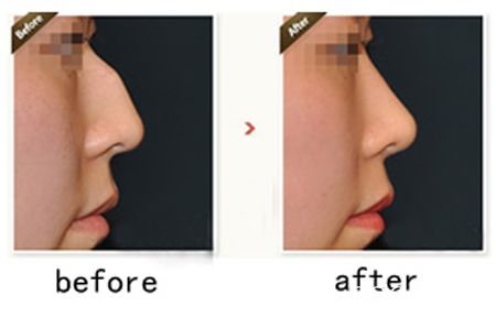 韩国多友整形医院驼峰鼻矫正案例对比图 韩国多友整形医院驼峰鼻矫正案例对比图