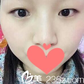 做双眼皮+开眼角术前照 做双眼皮+开眼角术前照