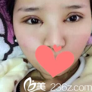 在韩国BCI做眼综合术后第3天照 在韩国BCI做眼综合术后第3天照