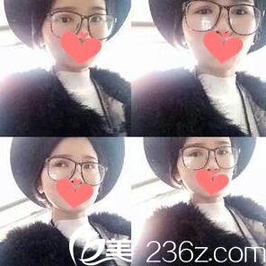 双眼皮+开眼角术后一周拆线 双眼皮+开眼角术后一周拆线