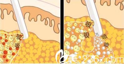 韩国张益秀整形外科张益秀抽脂塑形