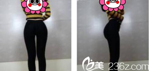 韩国张益秀整形外科张益秀抽脂瘦小腿真人案例术后十五天 韩国张益秀整形外科张益秀抽脂瘦小腿真人案例术后十五天