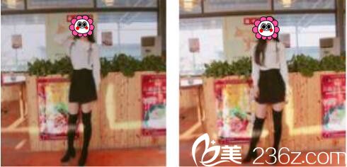 韩国张益秀整形外科张益秀抽脂瘦小腿真人案例术后一个月 韩国张益秀整形外科张益秀抽脂瘦小腿真人案例术后一个月