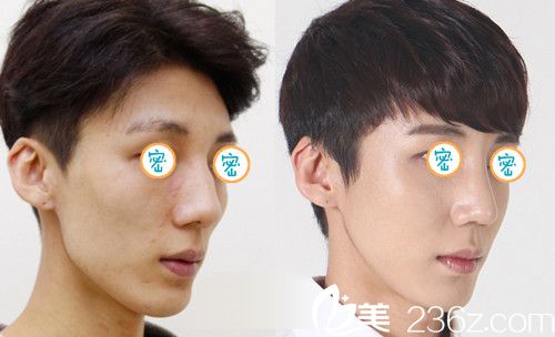  赵修永院长鼻部整形案例