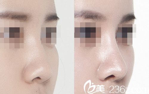  赵修永院长隆鼻手术案例