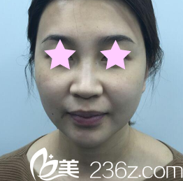 我在太原欧美莲整形美容医院做面部线雕提升前的照片 我在太原欧美莲整形美容医院做面部线雕提升前的照片