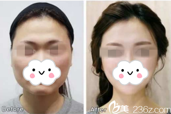 金柱奉面部轮廓整形真人案例