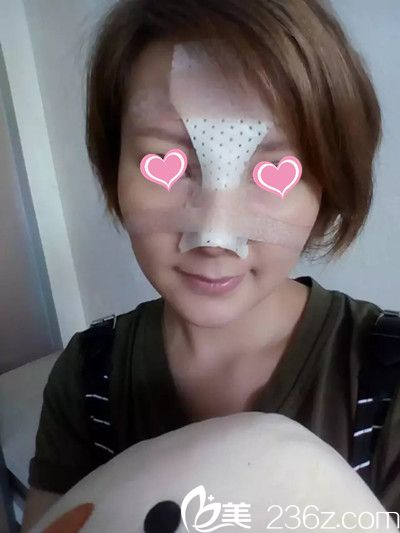 鼻综合手术后3天