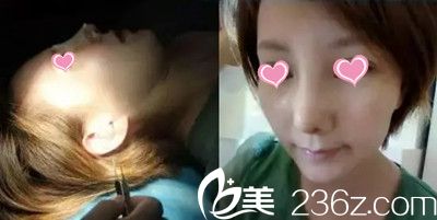 韩国赵修永鼻修复手术案例