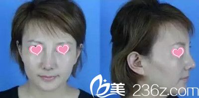 赵修永院长鼻综合手术案例