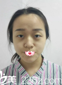 术前是无神单眼皮 术前是无神单眼皮