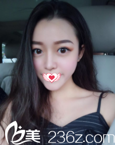 在唐山颐安娜做完切开双眼皮术后由无神单眼皮蜕变成睫毛自然上翘的灵动大双眼