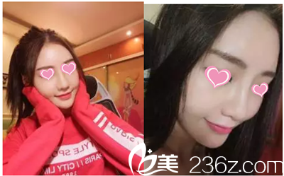 韩国雅佳整形医院隆鼻手术案例