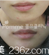 韩国Pomme breast整形外科下巴整形案例 韩国Pomme breast整形外科下巴整形案例