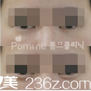 韩国Pomme breast整形外科卧蚕再造案例 韩国Pomme breast整形外科卧蚕再造案例