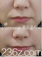 韩国Pomme breast整形外科去除法令纹案例 韩国Pomme breast整形外科去除法令纹案例