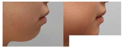 假体垫下巴案例对比驼峰鼻矫正对比案例	