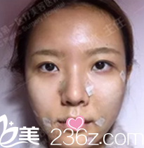 北京联合丽格悦生线面部提升当天样子