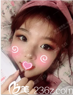 北京联合丽格隋冰悦生线面部提升案例第15天效果