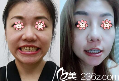 金元镇院长牙齿矫正案例 金元镇院长牙齿矫正案例