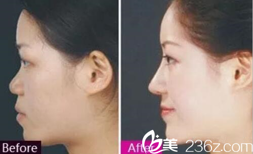 金英祖院长隆鼻案例 金英祖院长隆鼻案例