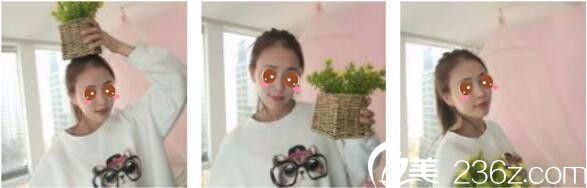 韩国Toxnfill整形外科宋仁权瘦脸除皱瘦真人案例术后十五天