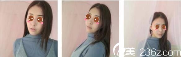 韩国Toxnfill整形外科宋仁权瘦脸除皱瘦真人案例术后一个月