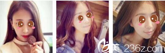 韩国Toxnfill整形外科宋仁权瘦脸除皱瘦真人案例术后两个月