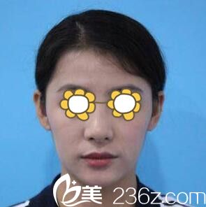 在韩国丽丝做鼻整形术前照 在韩国丽丝做鼻整形术前照