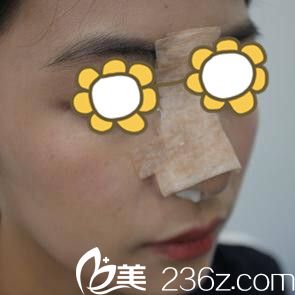 找金均泰做鼻整形术后第2天 找金均泰做鼻整形术后第2天