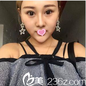 在北京知音做眼综合第23天 在北京知音做眼综合第23天