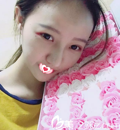 之前在唐山艾玲做双眼皮效果自然无痕 后来又找谢艾玲院长做完假体隆鼻后拥有精致美鼻