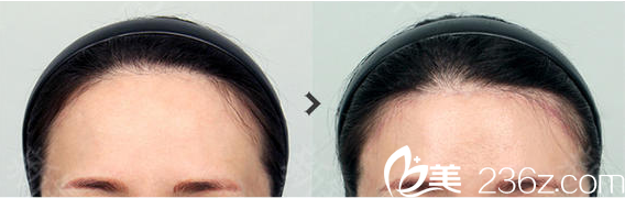 韩国TAILOR卓佑炫整形内视镜额头提升术案例对比图 韩国TAILOR卓佑炫整形内视镜额头提升术案例对比图